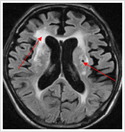 脳血管性認知症の方の頭部MRI画像